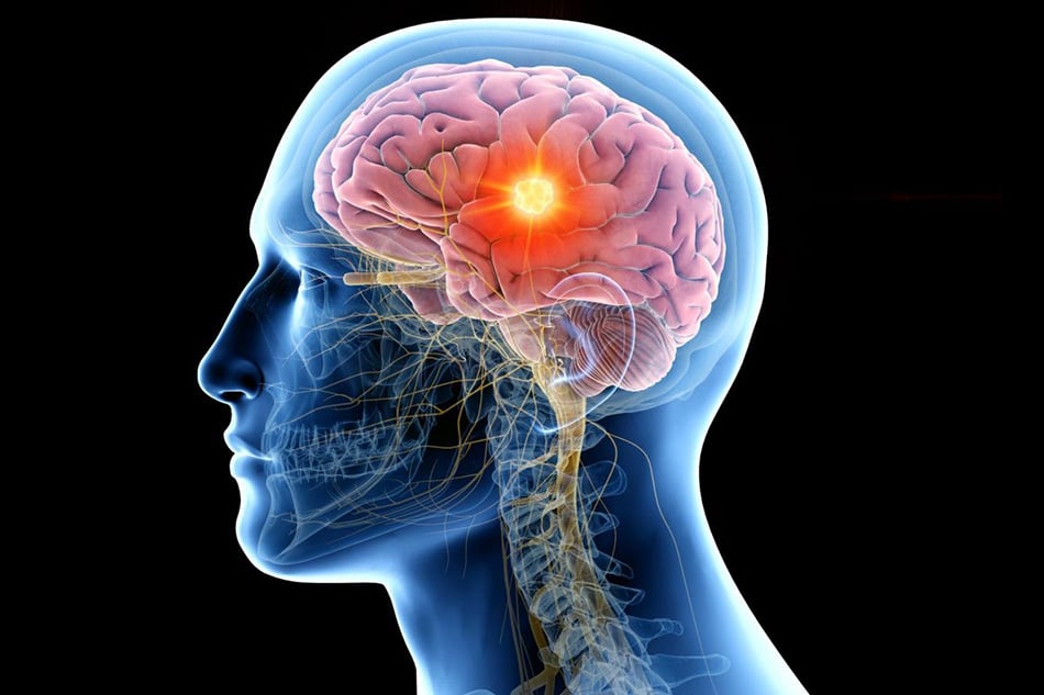acquired brain injury